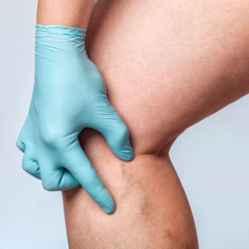 Phlebitis: Mi ez, okai és kezelése